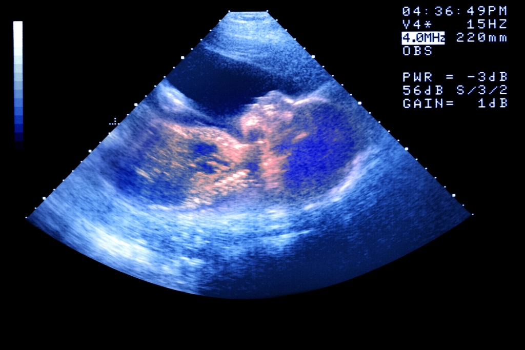 ‘Life has changed a whole lot and for the better:’ IVF Treatment Continues During Pandemic Via Telehealth