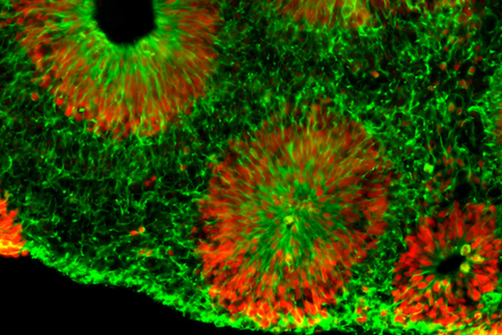 Fragile X syndrome: Human brain organoids model disorder more closely than mice