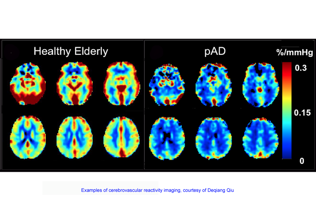 Emory researchers awarded $3.8 million to advance Alzheimer’s brain imaging : Emory University : Atlanta GA