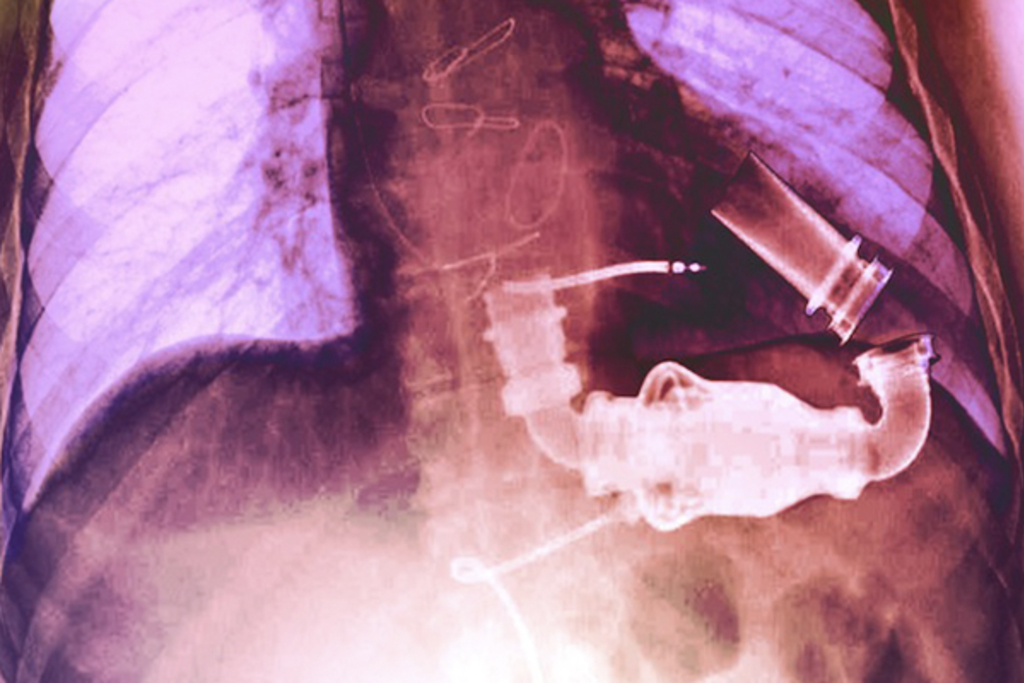 Emory heart team implants 500th lifesaving left ventricular assist device (LVAD) : Emory University : Atlanta GA